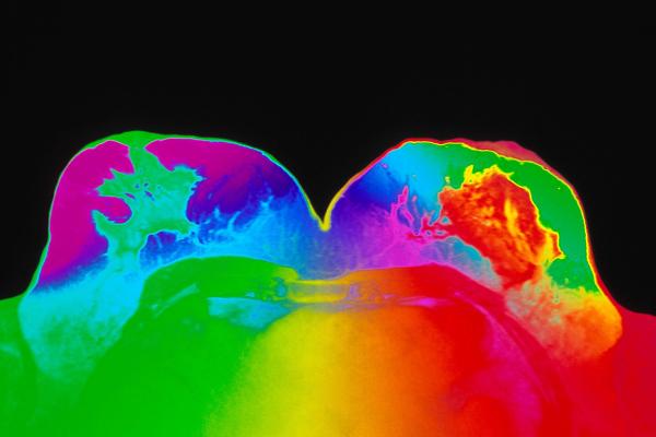 Coloured-MRI-scan-of-healthy-breasts-of-a-woman.jpg